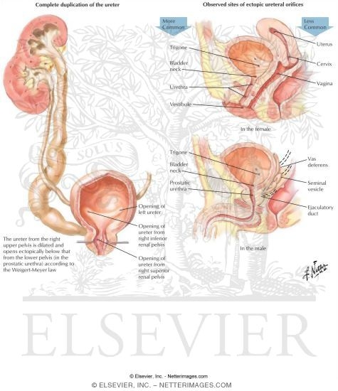 Ectopic Ureters