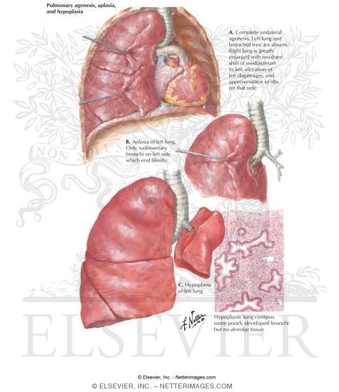 Airway Branching Anomalies