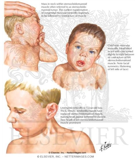 Congenital Muscular Torticollis (Wryneck)