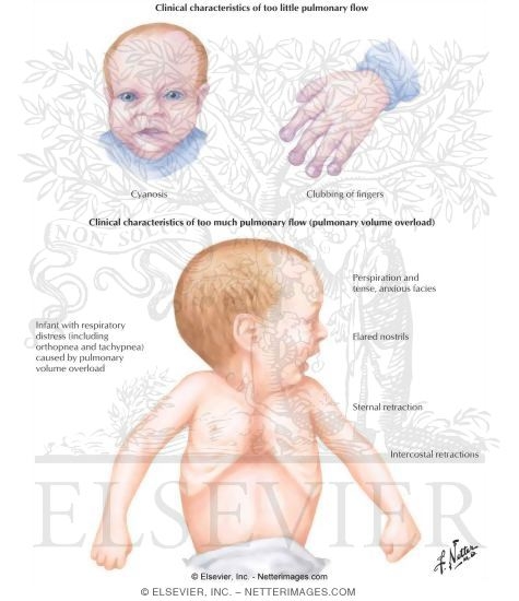 Watermarked preview of labeled image: Congenital Heart Defect Concepts