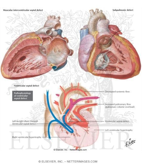 Watermarked preview of labeled image: Ventricular Septal Defects