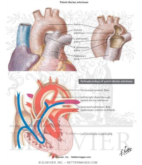 Watermarked preview of labeled image: Patent Ductus Arteriosus