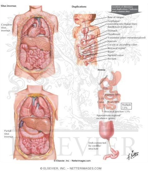 Duplication, Atresia, and Situs Inversus