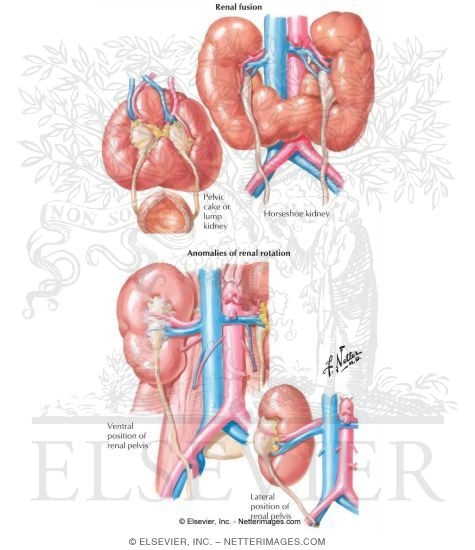 Kidney Rotation Anomalies and Renal Fusion