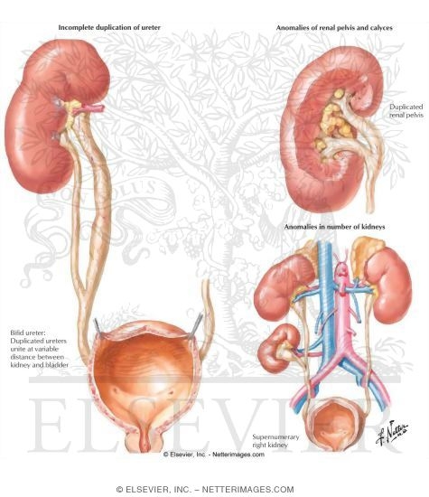 Watermarked preview of labeled image: Ureteric Bud Duplication