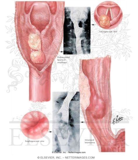 Watermarked preview of unlabeled image: Benign Neoplasms
