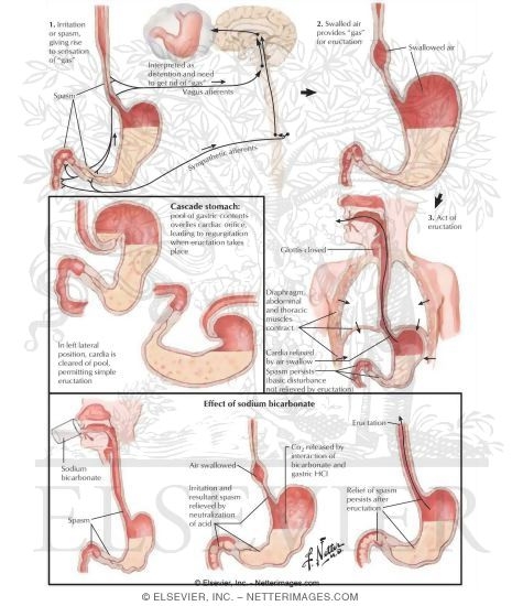 Aerophagia and Eructation