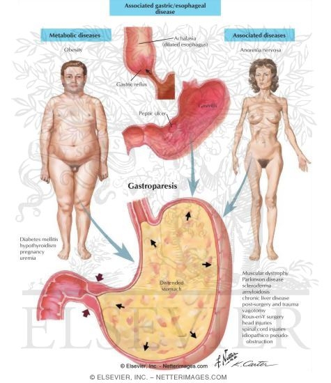 a study of gastroparesis a study of gastroparesis