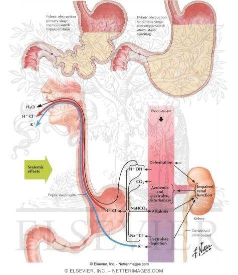 Watermarked preview of labeled image: Pyloric Obstruction and the Effects of Vomiting