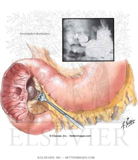 Watermarked preview of unlabeled image: Diverticula of the Duodenum