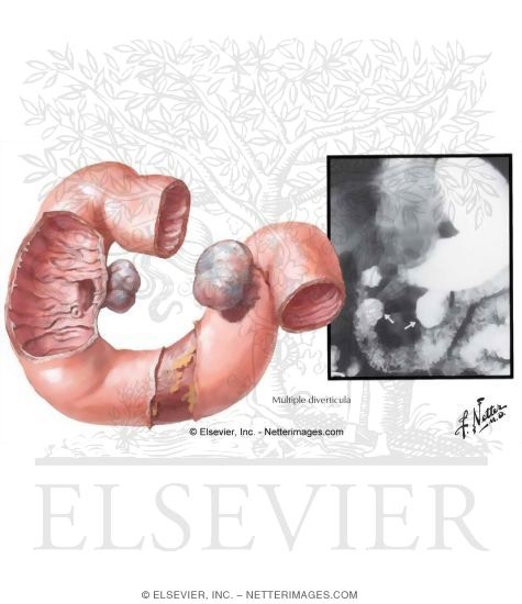 Watermarked preview of unlabeled image: Diverticula of the Duodenum