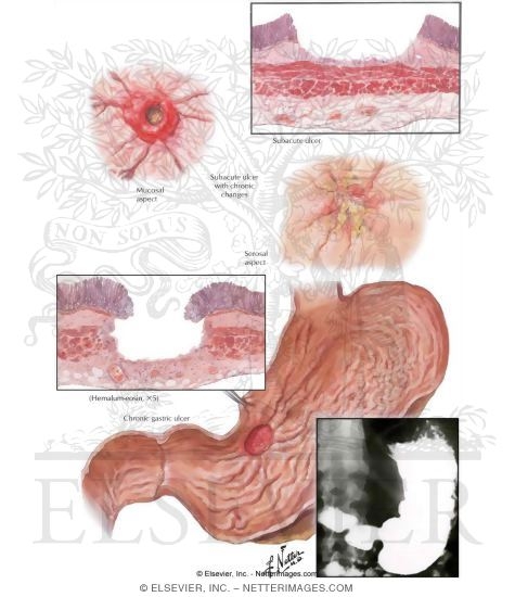 Watermarked preview of labeled image: Subacute and Chronic Gastric Ulcers
