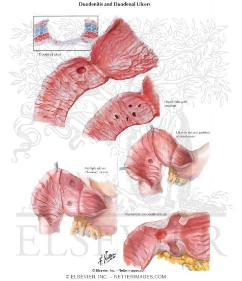 Watermarked preview of labeled image: Duodenitis and Duodenal Ulcers