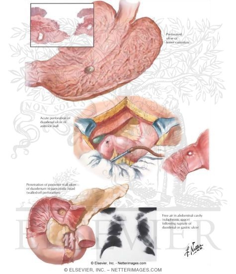 Watermarked preview of labeled image: Complications of Gastric and Duodenal Ulcers