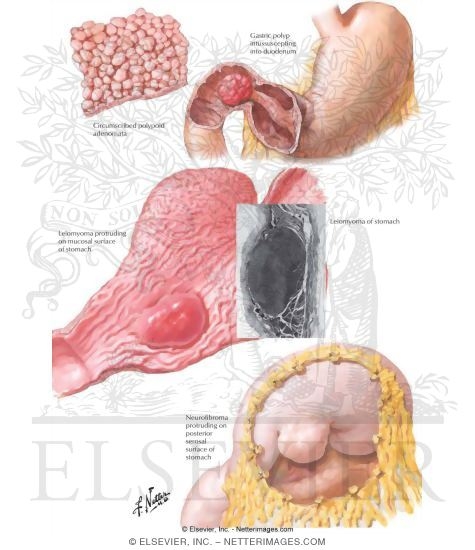 Watermarked preview of labeled image: Benign Gastric Tumors