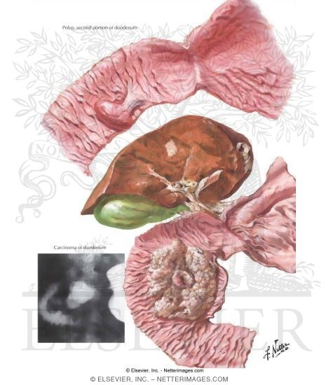 Watermarked preview of unlabeled image: Tumors of Duodenum