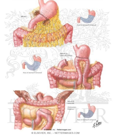 Watermarked preview of unlabeled image: Principles of Gastric Surgery