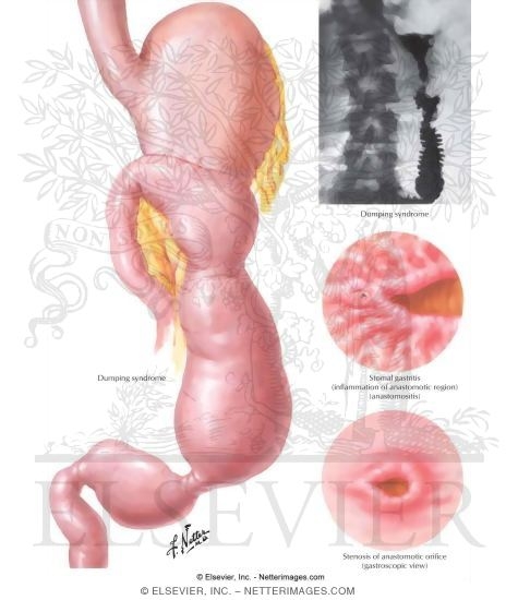Postgastrectomy Complications Partial Gastrectomy