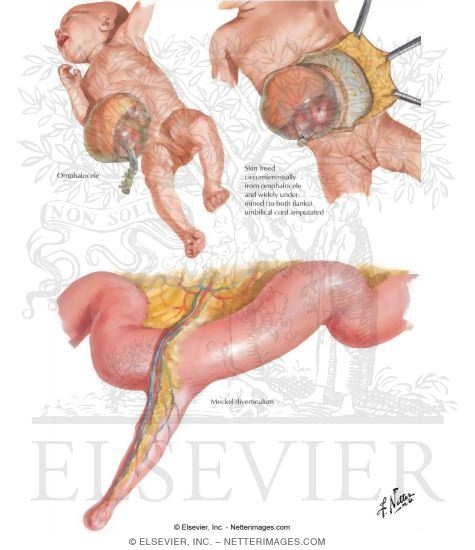 Watermarked preview of labeled image: Abdominal Wall and Cavity: Congenital Abnormalities