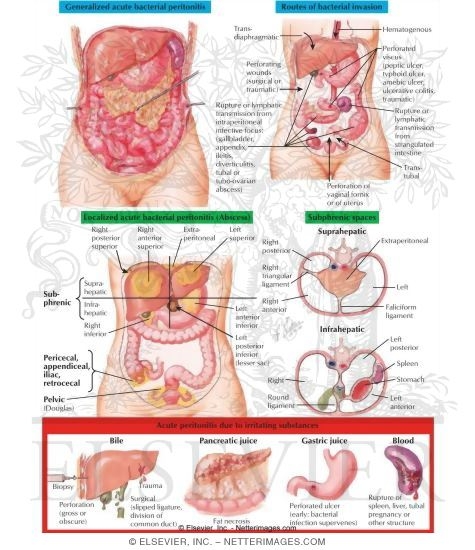 Acute Peritonitis