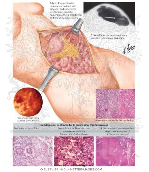 Watermarked preview of labeled image: Chronic Peritonitis