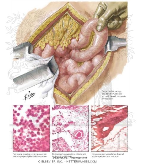 Benign Paroxysmal Peritonitis Or Familial Mediterranean Fever
