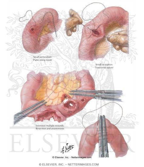 Watermarked preview of labeled image: Abdominal Wounds I - Small Intestine