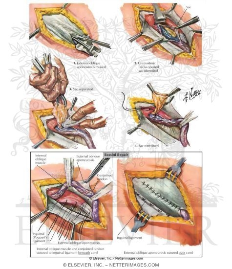 Watermarked preview of labeled image: Hernia I - Indirect and Direct Inguinal Hernias
