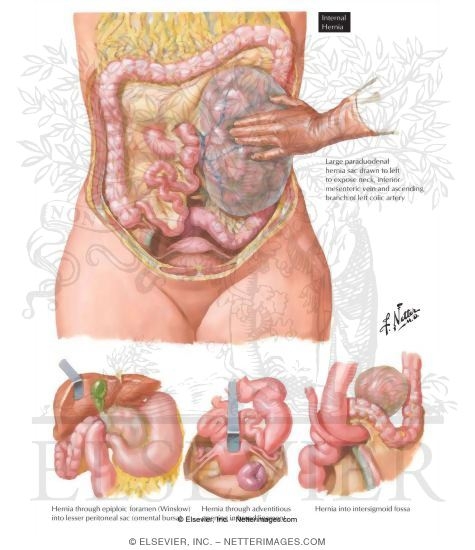 Watermarked preview of labeled image: Hernia VII - Internal Hernia