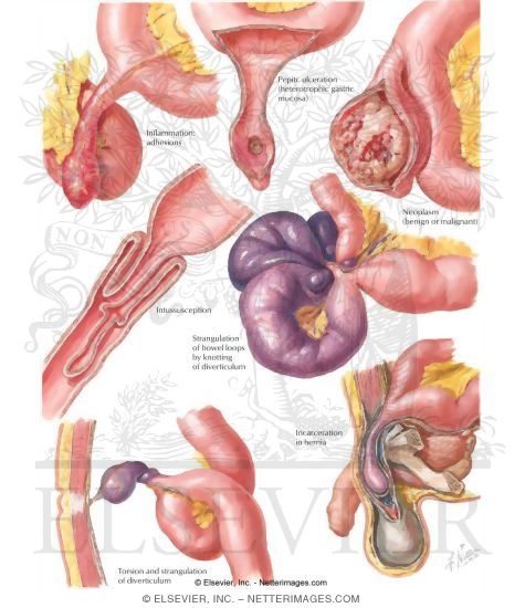 Meckel Diverticulum - Vitelline Duct Remnants