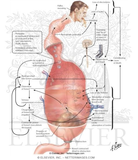 Intestinal Obstruction, Adynamic Ileus