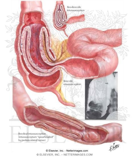 Watermarked preview of labeled image: Intussusception