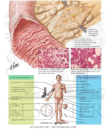 Intestinal Lipodystrophy