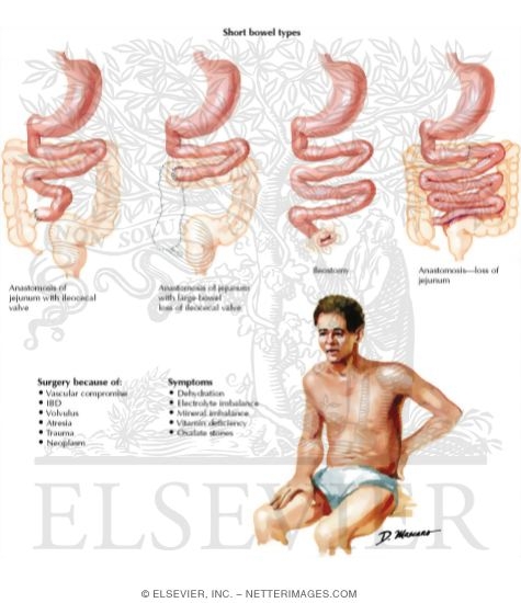 Watermarked preview of unlabeled image: Short Bowel Syndrome