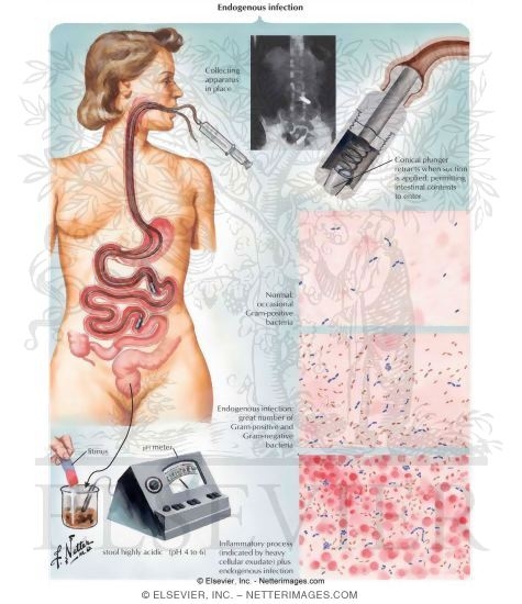 Watermarked preview of unlabeled image: Intestinal Disturbances Resulting From Food Allergy