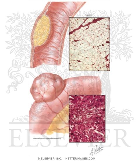 Watermarked preview of unlabeled image: Benign Tumors