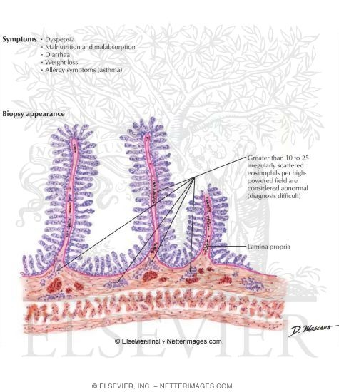 Eosinophilic Gastroenteritis