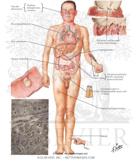 Carcinoid Syndrome