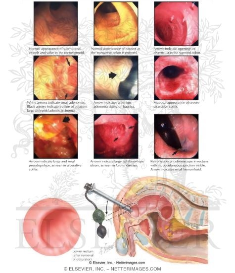 Anoscopy, Sigmoidoscopy, and Colonoscopy