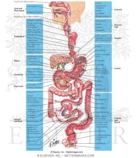 Gastrointestinal Hemorrhage