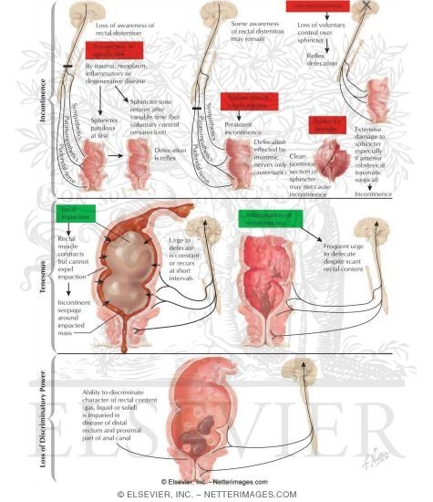 Watermarked preview of labeled image: Pathophysiology of Defecation