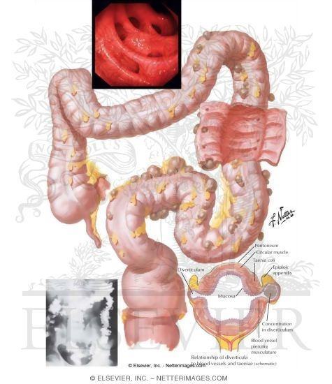 Watermarked preview of labeled image: Diverticulosis   