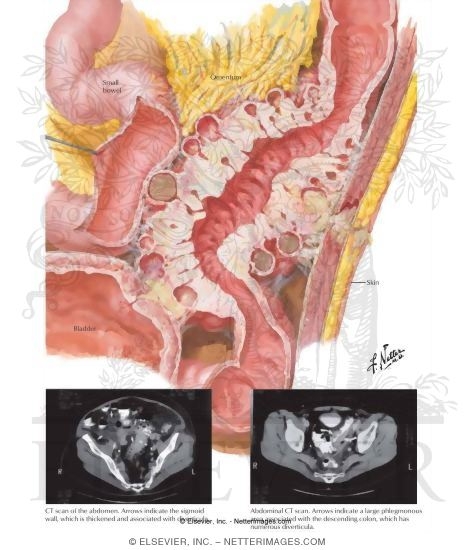 Watermarked preview of labeled image: Diverticulitis, With CT Scans Showing a Thickened Wall and Diverticula