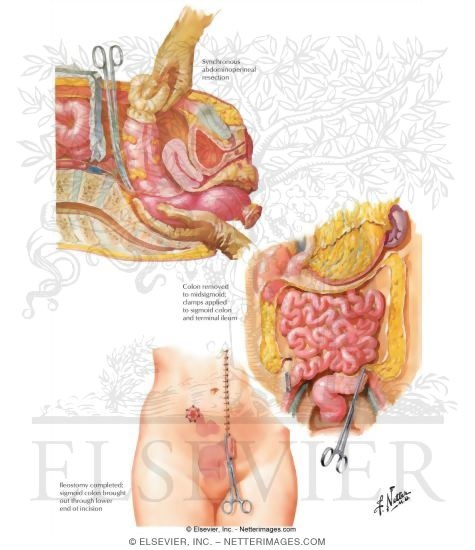 Ulcerative Colitis: Ileostomy and Subtotal Colectomy, and Synchronous Abdominoperineal Resection