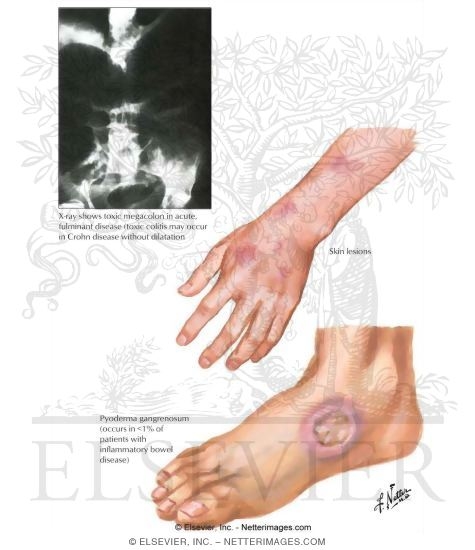 Watermarked preview of labeled image: Ulcerative Colitis: Extraintestinal Manifestations and Complications