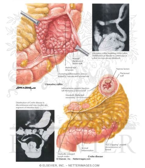 Watermarked preview of labeled image: Differentiating Features of Ulcerative Colitis and Crohn Disease