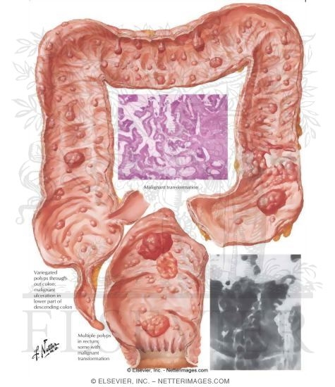 Watermarked preview of labeled image: Familial Polyposis of Large Intestine