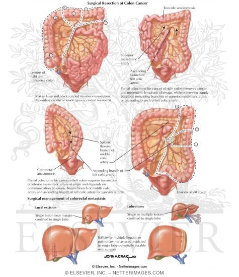 Watermarked preview of labeled image: Colon Cancer: Staging, Treatment, and Outcome
