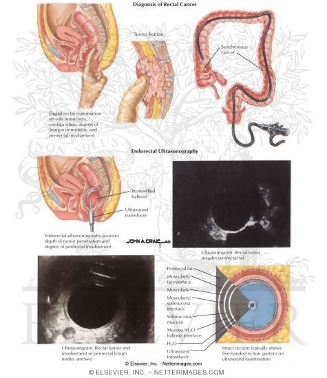 Watermarked preview of labeled image: Rectal Cancer