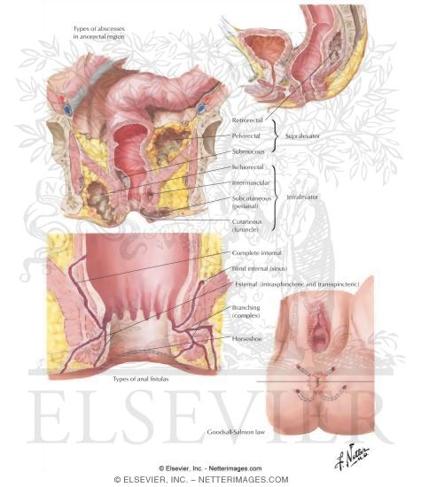 Watermarked preview of labeled image: Proctologic Conditions IV - Anorectal Abscess and Fistula